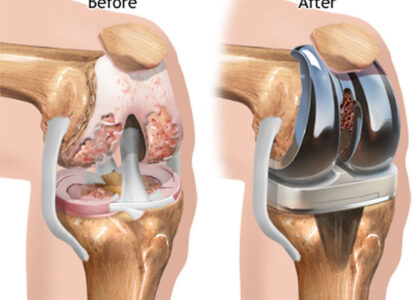 United States Knee Replacement Industry