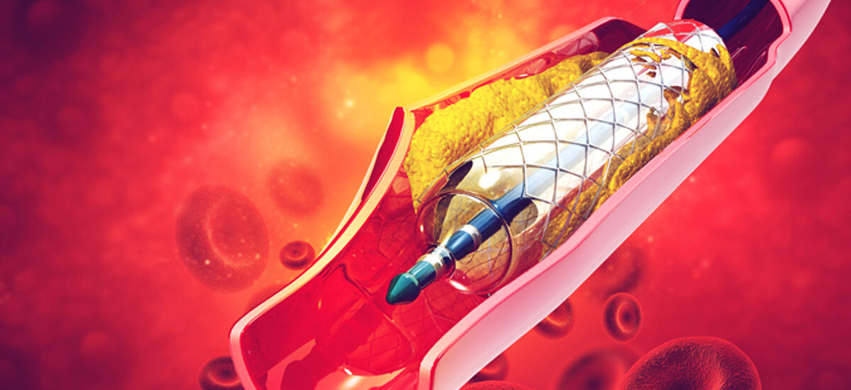 Venous Stents Market