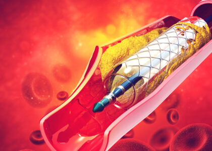 Venous Stents Market