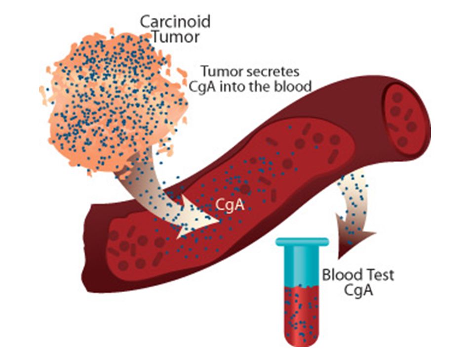 Carcinoid Tumor Syndrome Management Industry