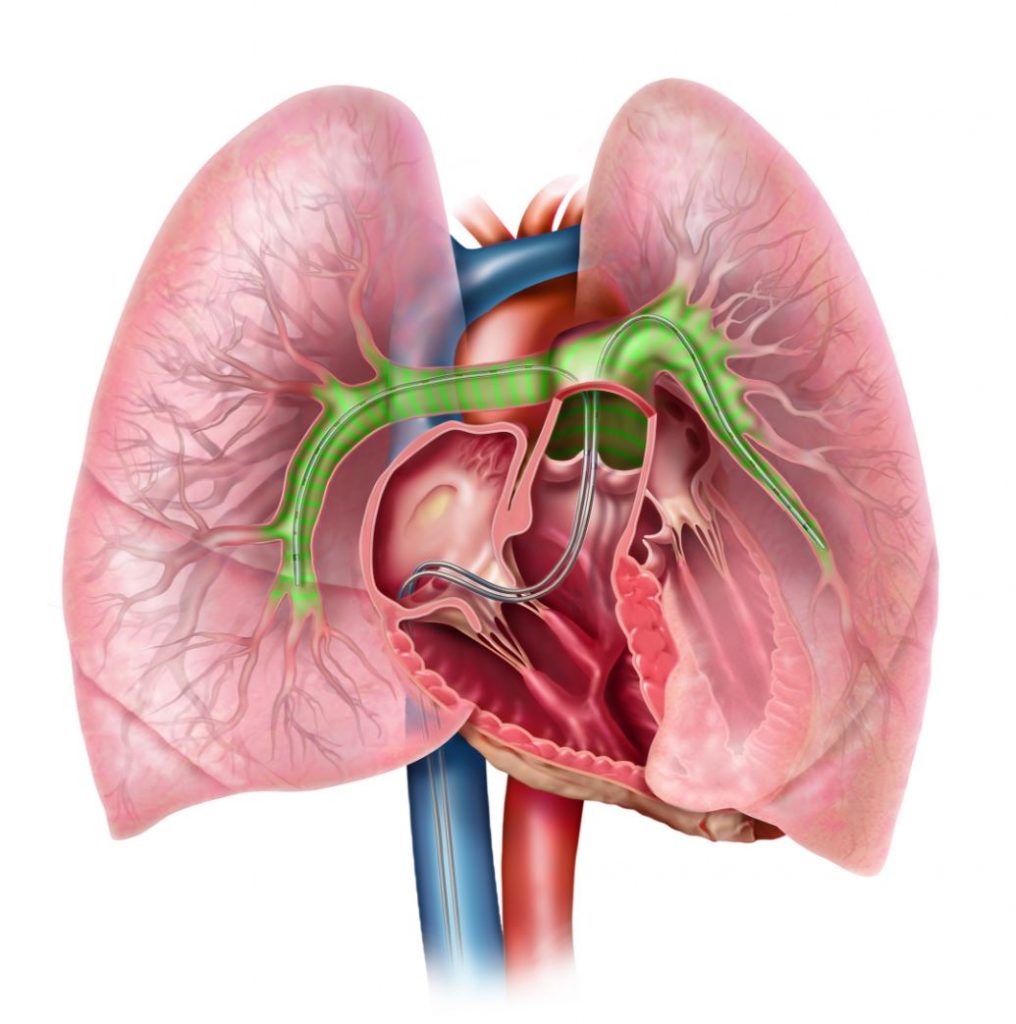 Catheter-Directed Thrombolysis Industry