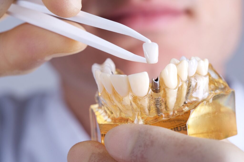 Dental Implants and Prosthetics Industry