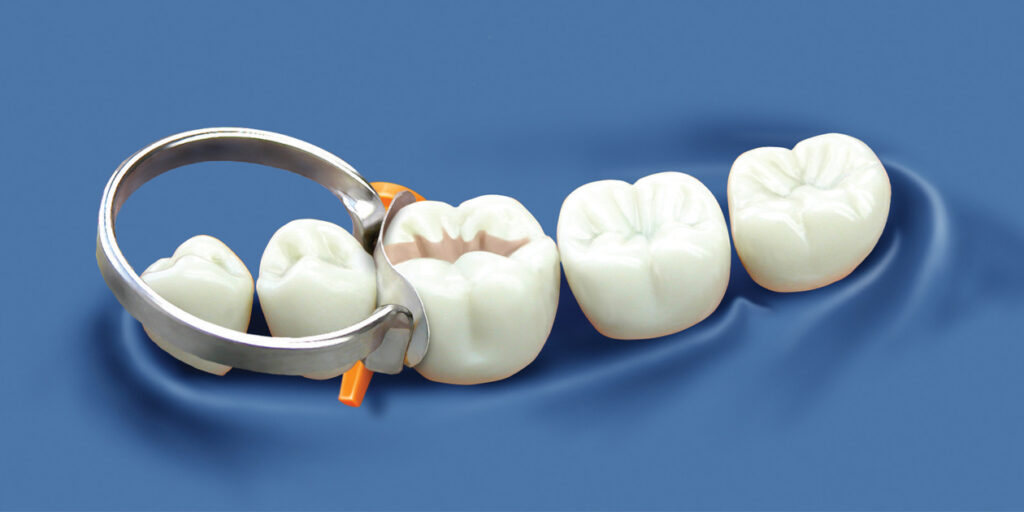 Dental Matrix Systems Market