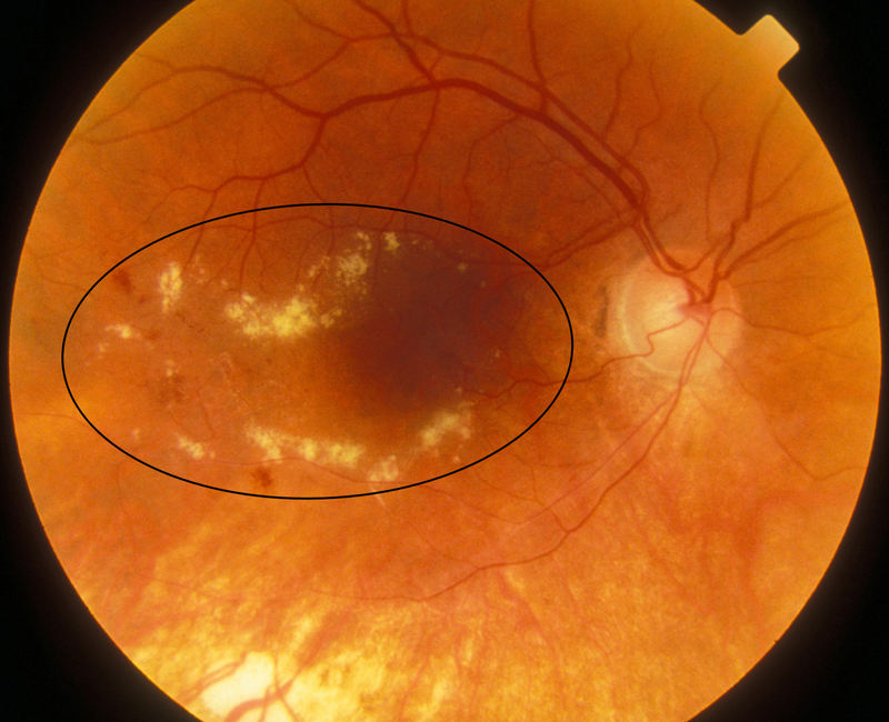 Diabetic Macular Edema Market