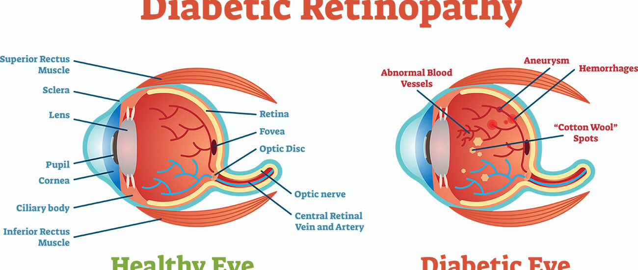 Global Diabetic Retinopathy Industry