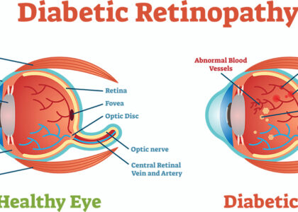 Global Diabetic Retinopathy Industry