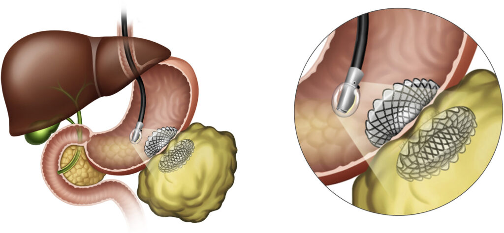 Gastrointestinal Stent Market