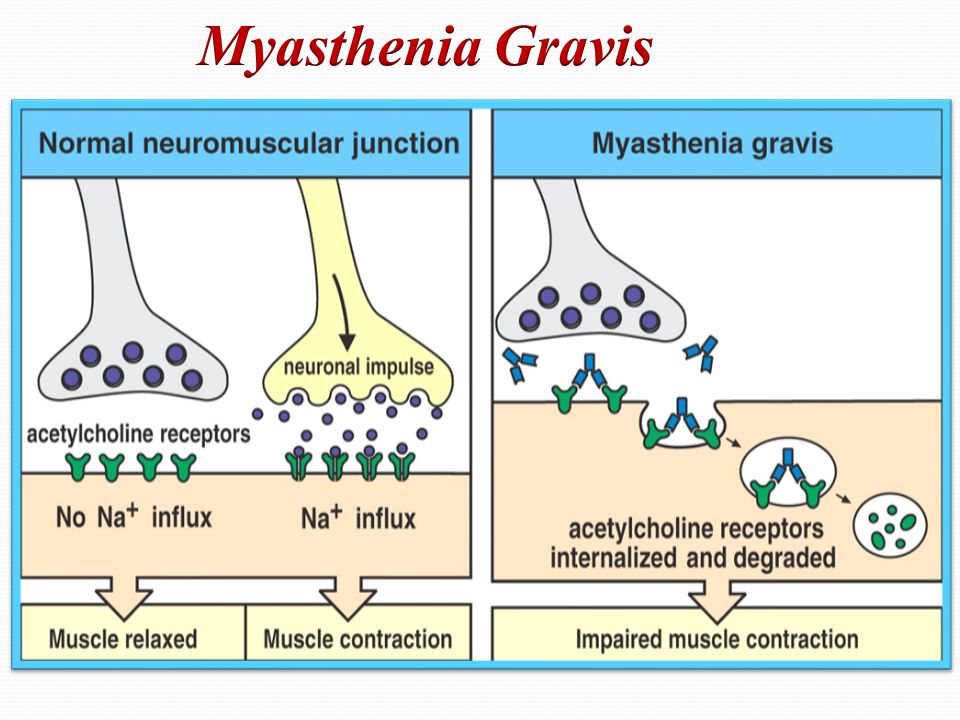 Generalized Myasthenia Gravis (GMG) Management Industry