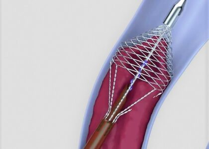 Global Neurovascular Devices Interventional Neurology Industry