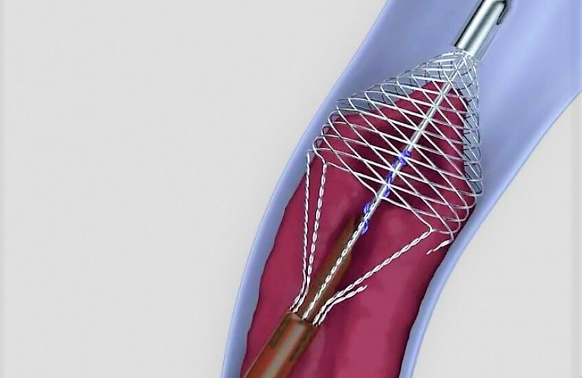 Global Neurovascular Devices Interventional Neurology Industry