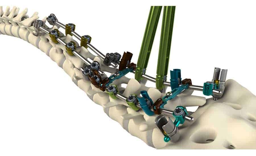 Global Thoracolumbar Stabilization Devices Industry