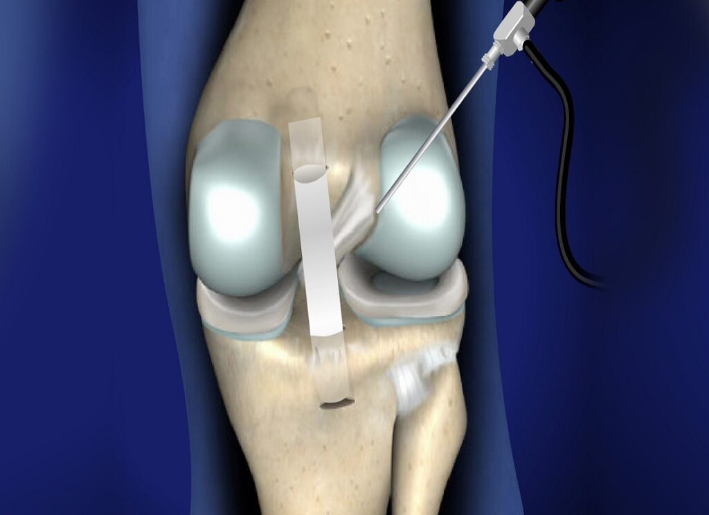 Ligament Augmentation Industry