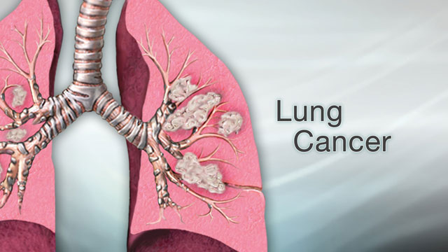 Lung Cancer PCR Panel Market