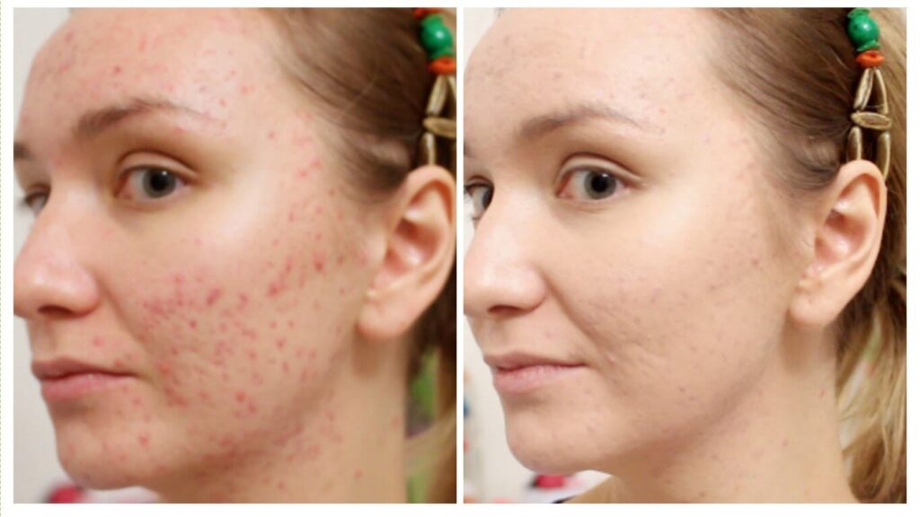 Moderate-to-Severe Acne Treatment Market