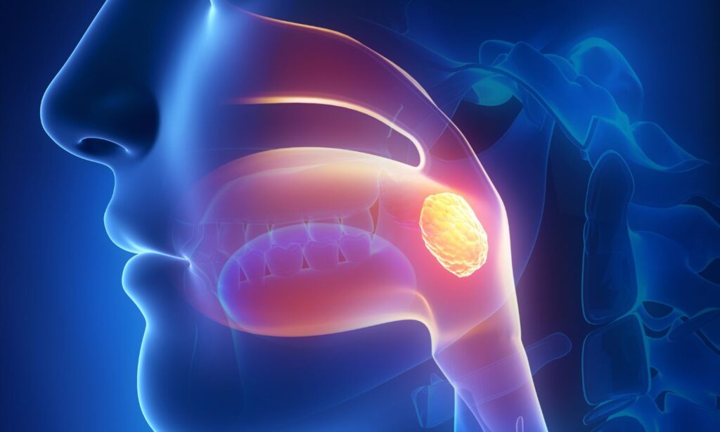 Nasopharyngeal Carcinoma Treatment Market