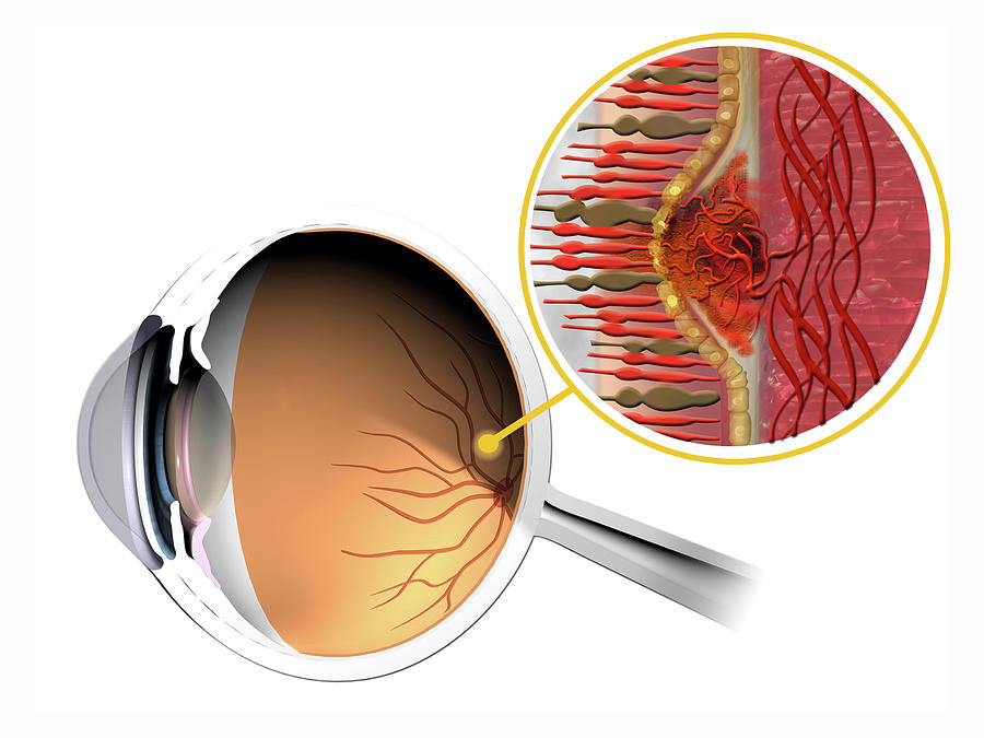 Neovascular Age-related Macular Degeneration Treatment Market