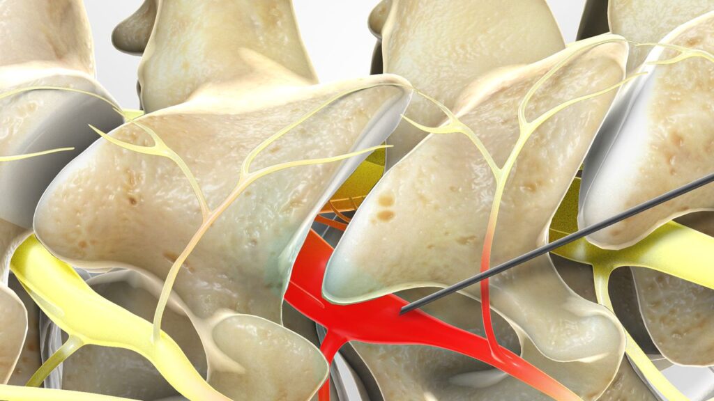 Nerve Entrapment Syndrome Therapeutics Market