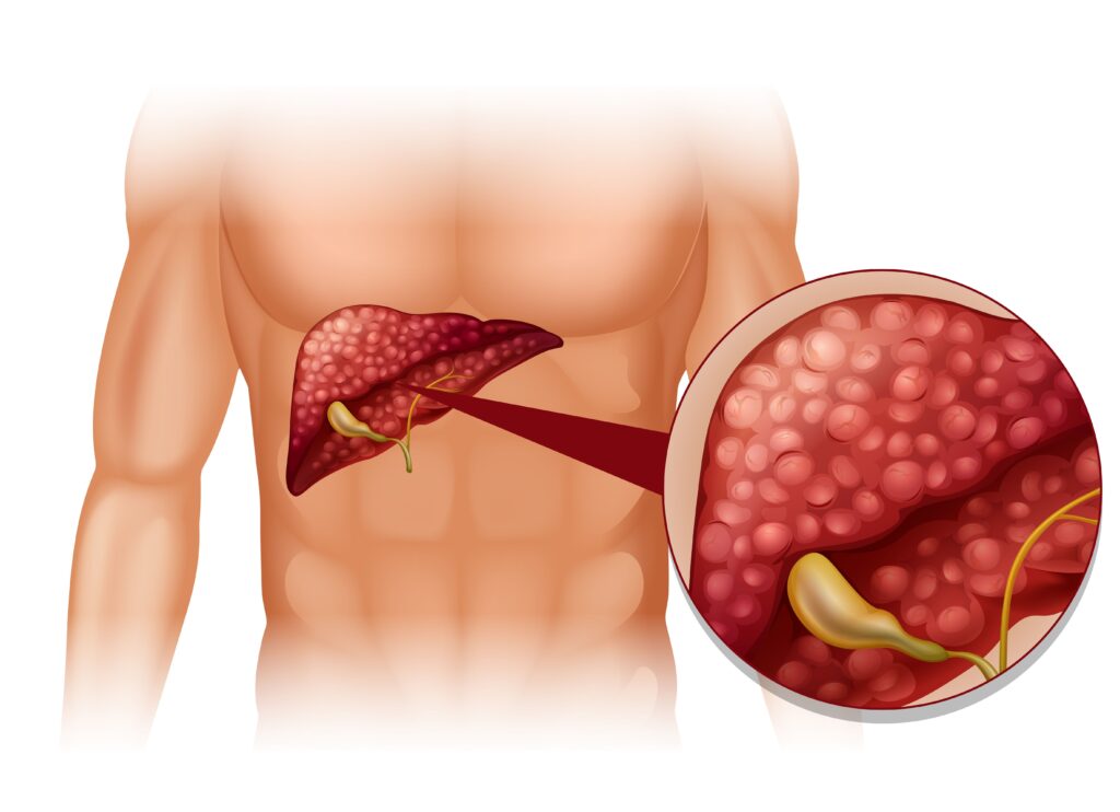 Neuroendocrine Carcinoma Treatment Market