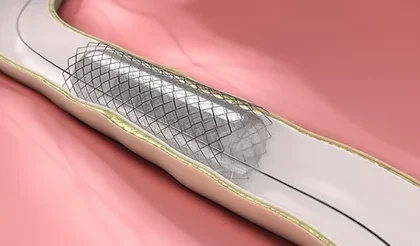 Peripheral Vascular Stent Market