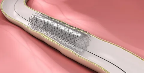 Peripheral Vascular Stent Market