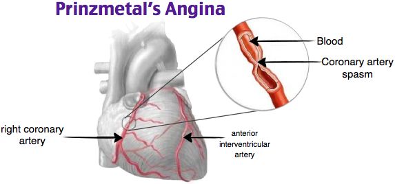 Prinzmetal Angina Therapeutics Industry