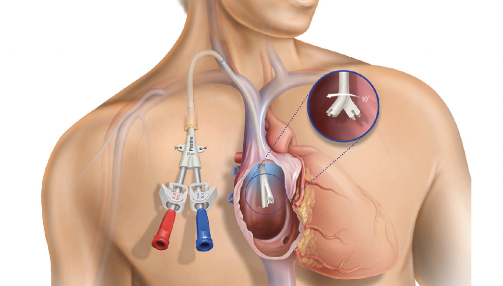 Sonohysterography Catheters Industry