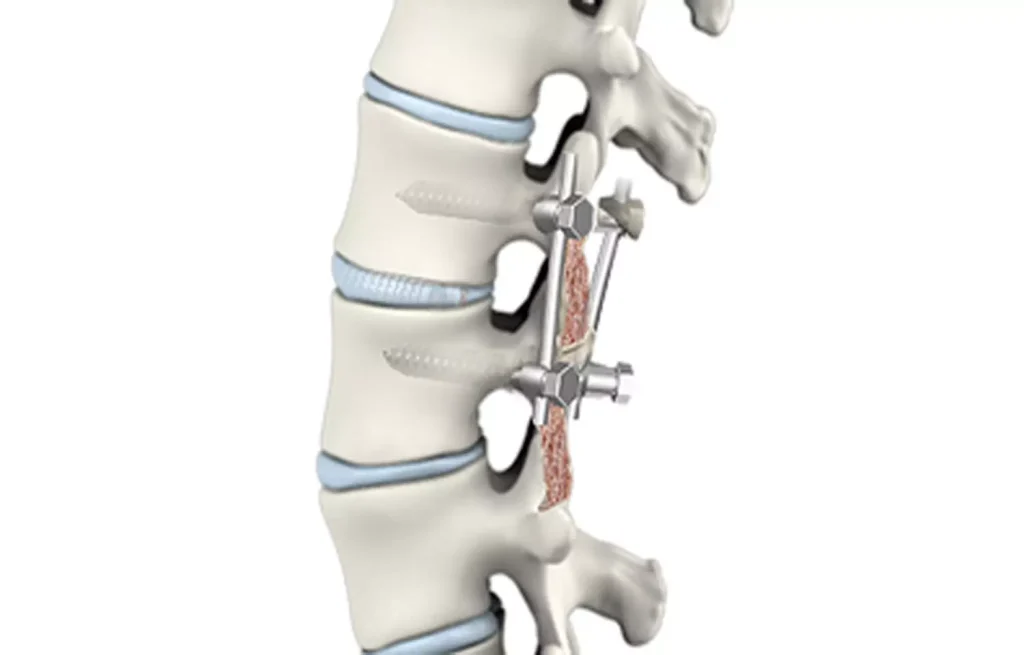 Spinal Fusion Market