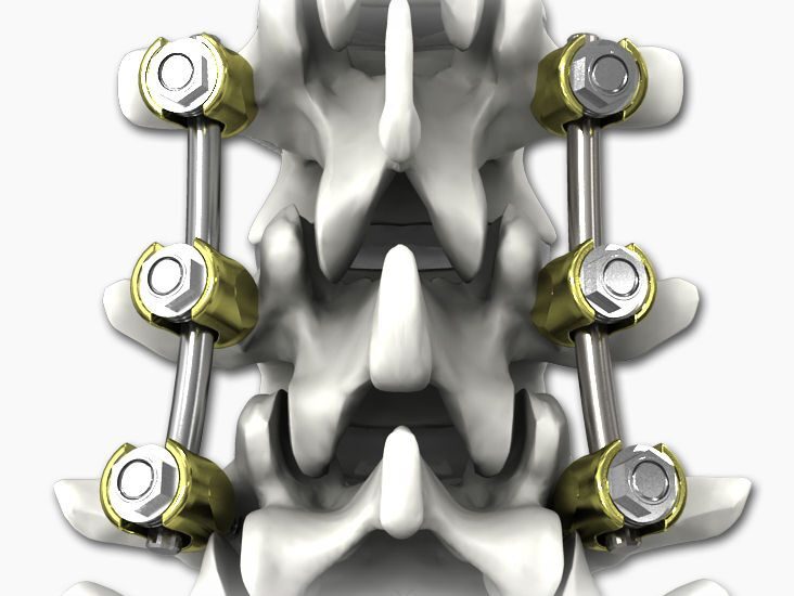 Global Spinal Osteosynthesis Units Market