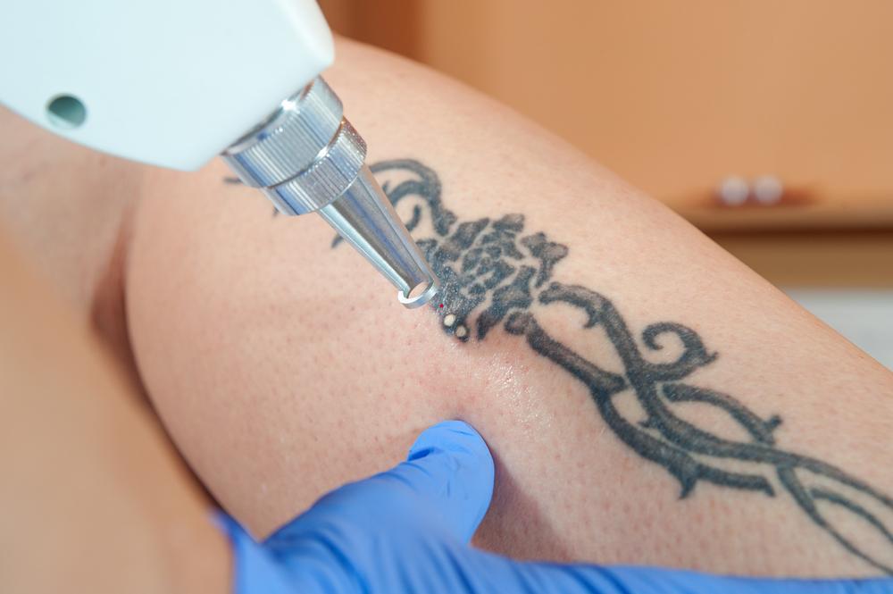 Tattoo Removal Lasers Market