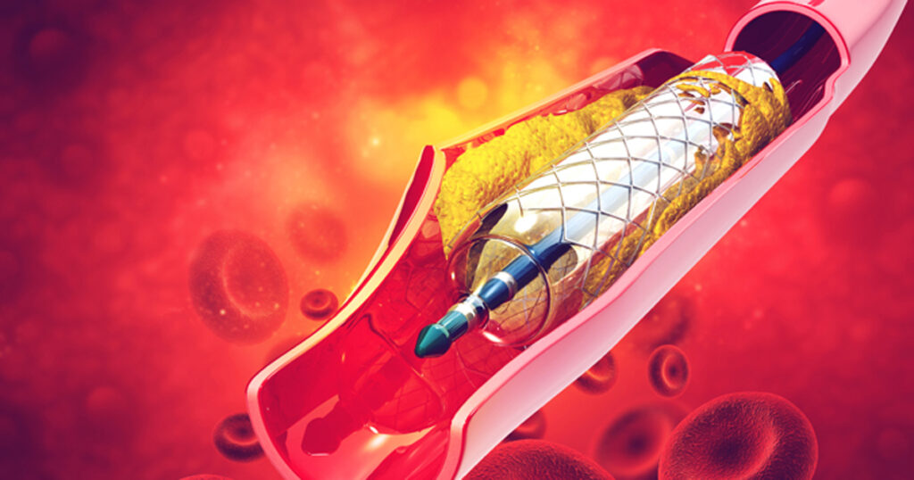 Venous Stents Market