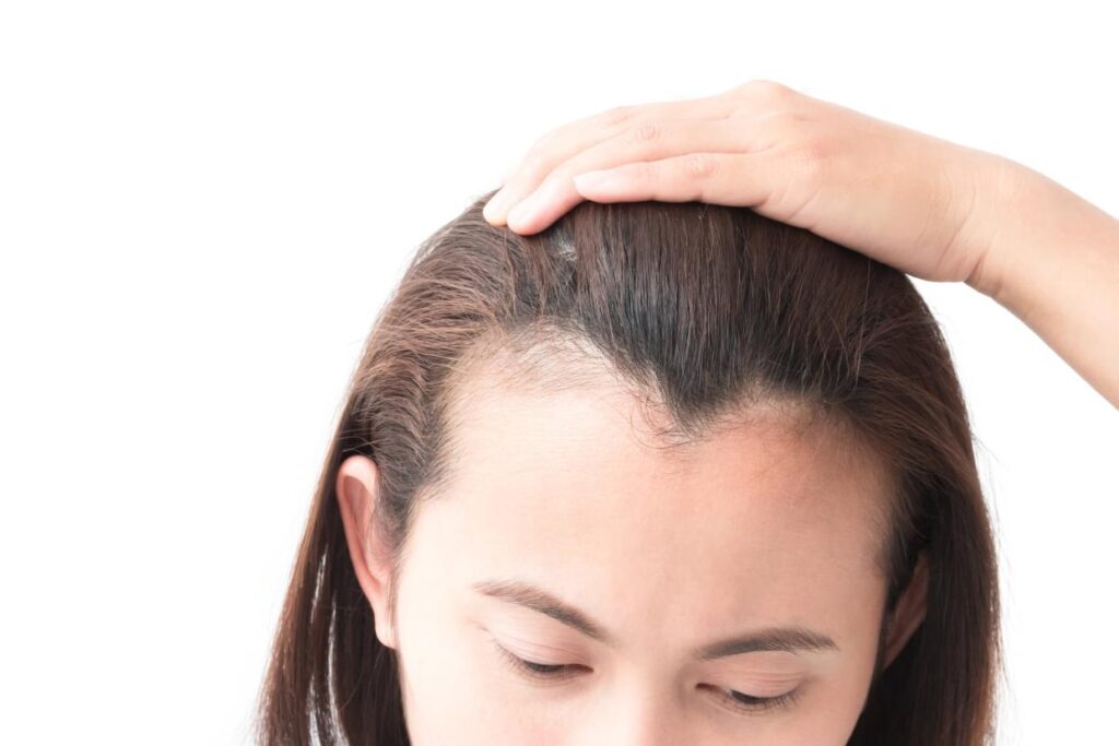 Alopecia Treatment Market