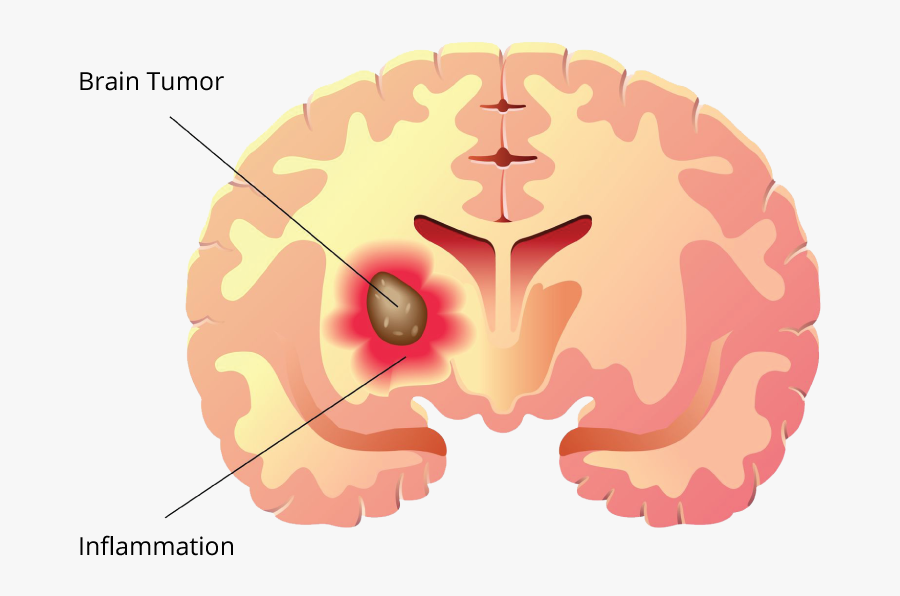 Brain Tumor Drugs Industry