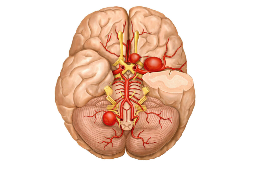 Cerebral Aneurysm Management Marlket