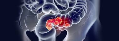 Colorectal Cancer Molecular Diagnostics Market