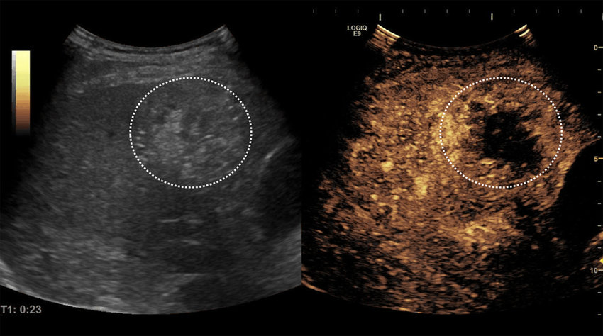 Contrast-Enhanced Ultrasound Industry