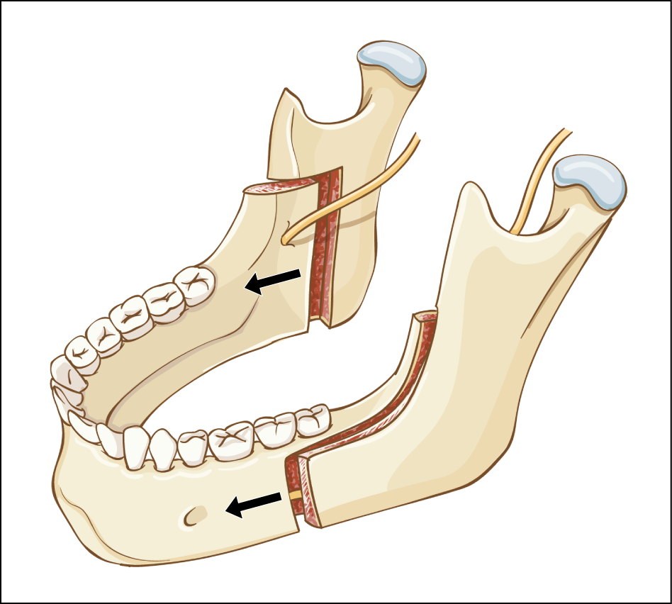 Craniofacial Implants Market