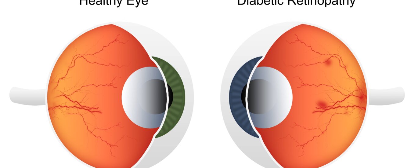 Global Diabetic Retinopathy Industry