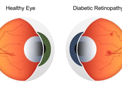 Global Diabetic Retinopathy Industry