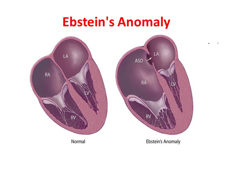 Ebstein's Anomaly Industry