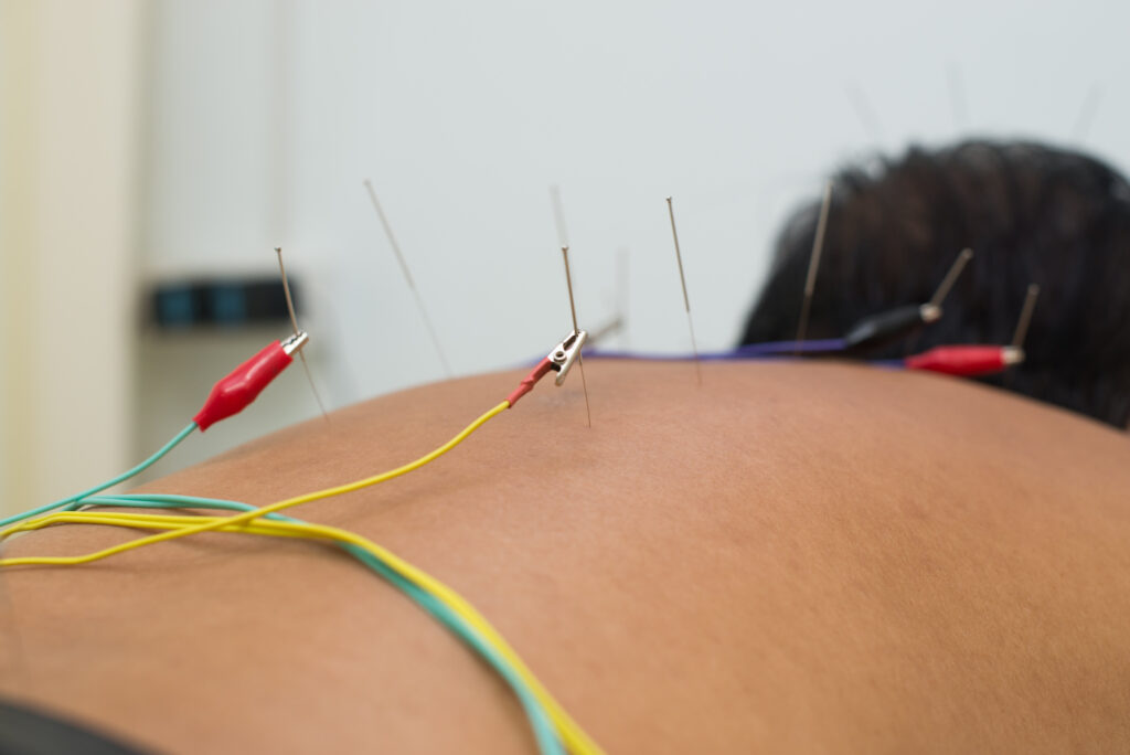 Electric Acupuncture Devices Industry