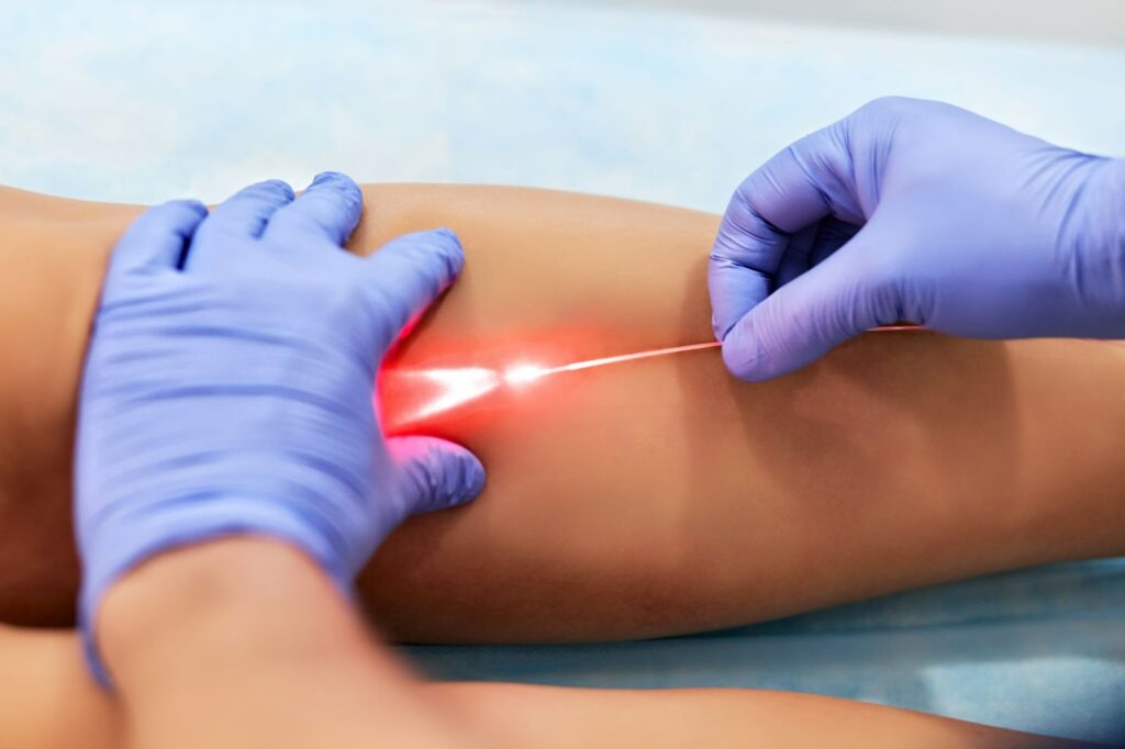 Endovenous Laser Therapy Market