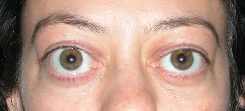 Exophthalmos Treatment Market