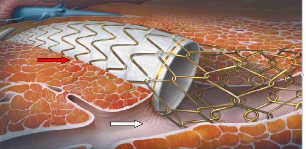 Gastrointestinal Stent Industry