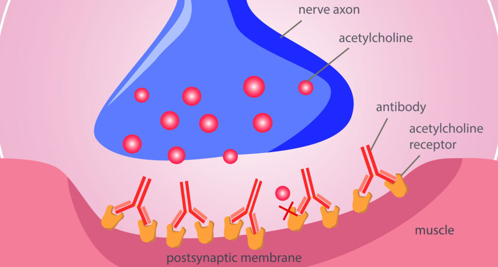 Generalized Myasthenia Gravis (GMG) Management Industry