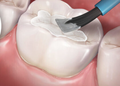 Global Dental Sealants Industry