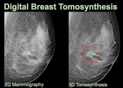 Digital Breast Tomosynthesis Equipment Market