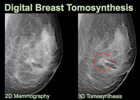 Digital Breast Tomosynthesis Equipment Market