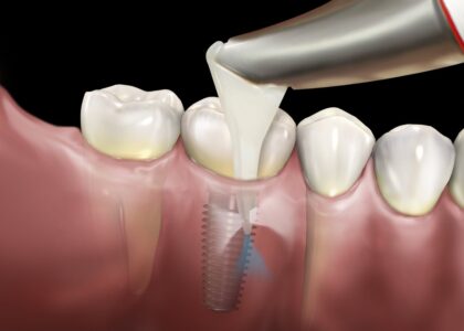 Global Peri-implantitis Treatment Industry