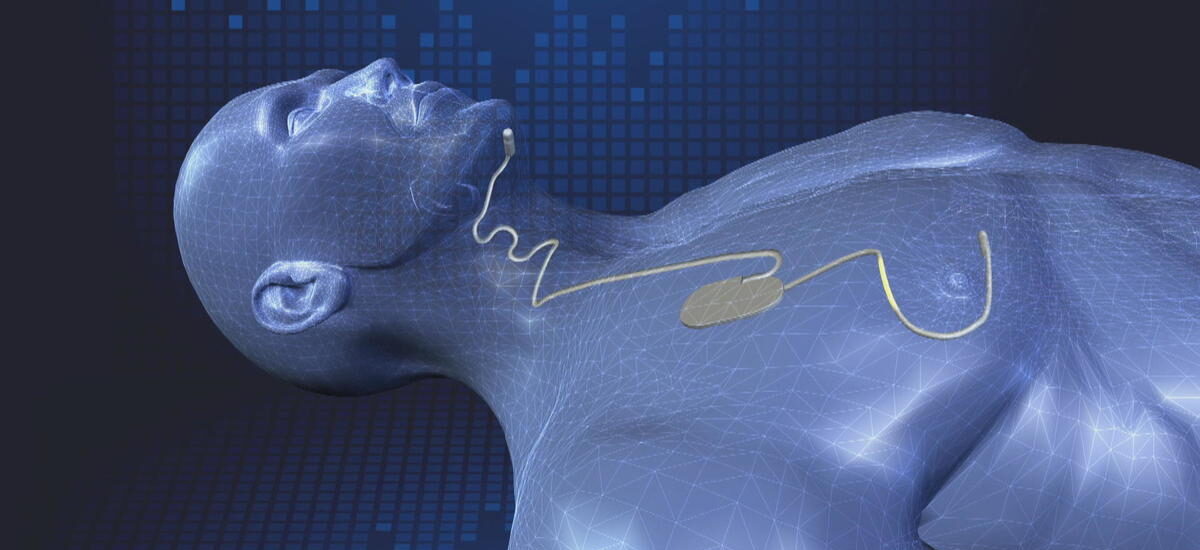 Global Sleep Apnea Implants Industry