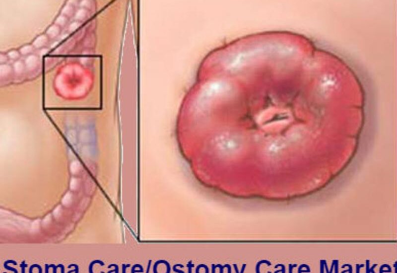 Global Stoma Ostomy Care Industry